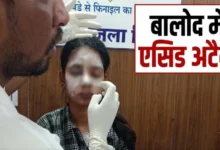 CG Crime News: 22-year-old woman attacked with acid in Balod; police scanning CCTV footage.