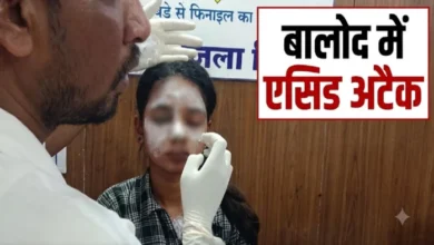 CG Crime News: 22-year-old woman attacked with acid in Balod; police scanning CCTV footage.