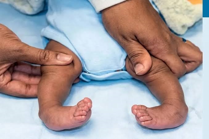 World Polio Day: Do not ignore this congenital condition affecting children's legs